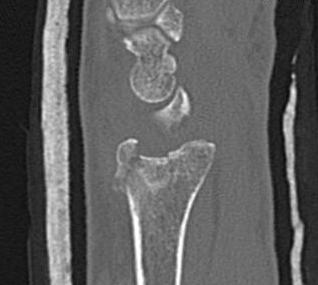 Distal Radius Fracture Articular Step Sagittal CT